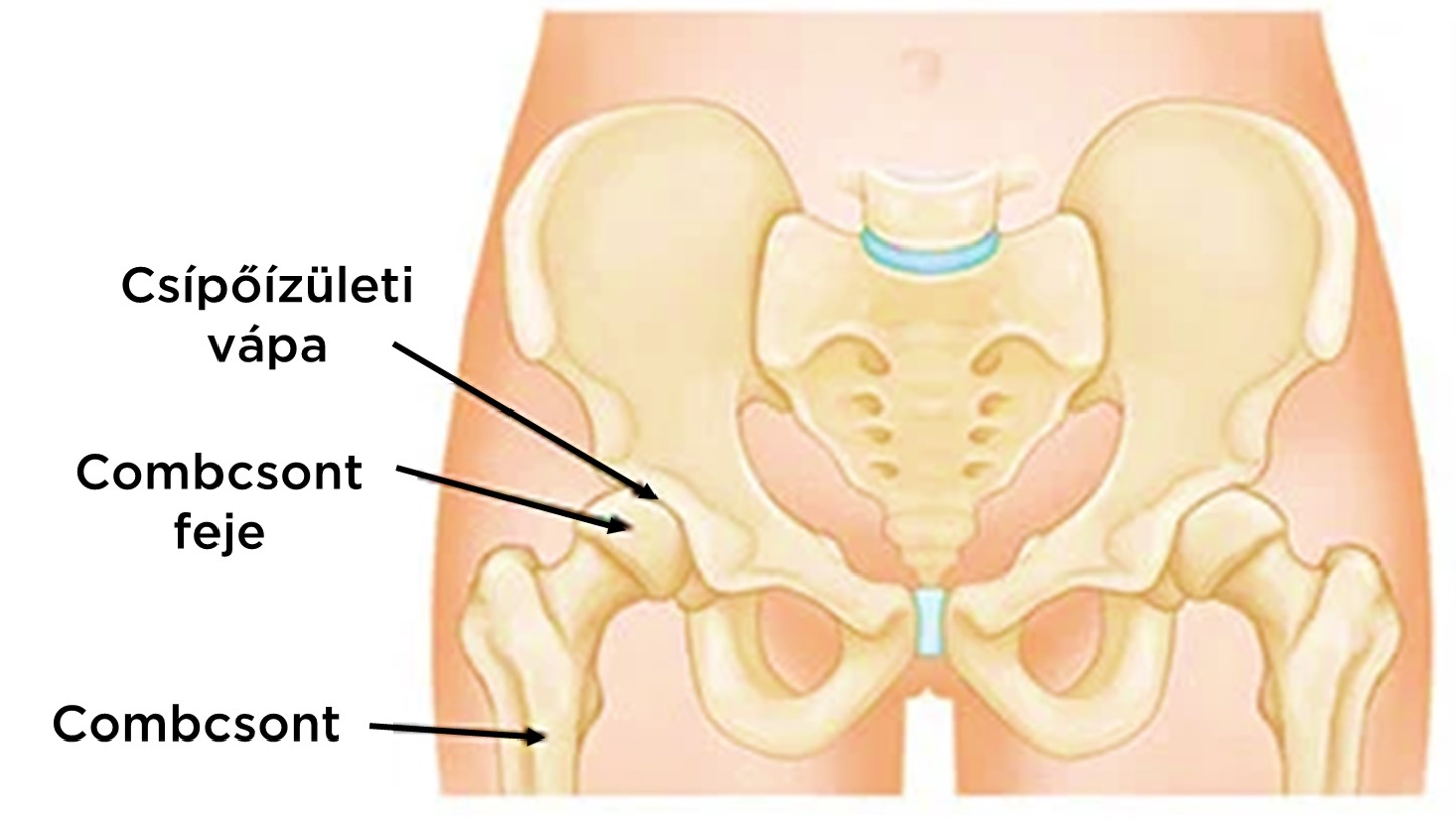 A csípőízület kopása - Okok és tünetek