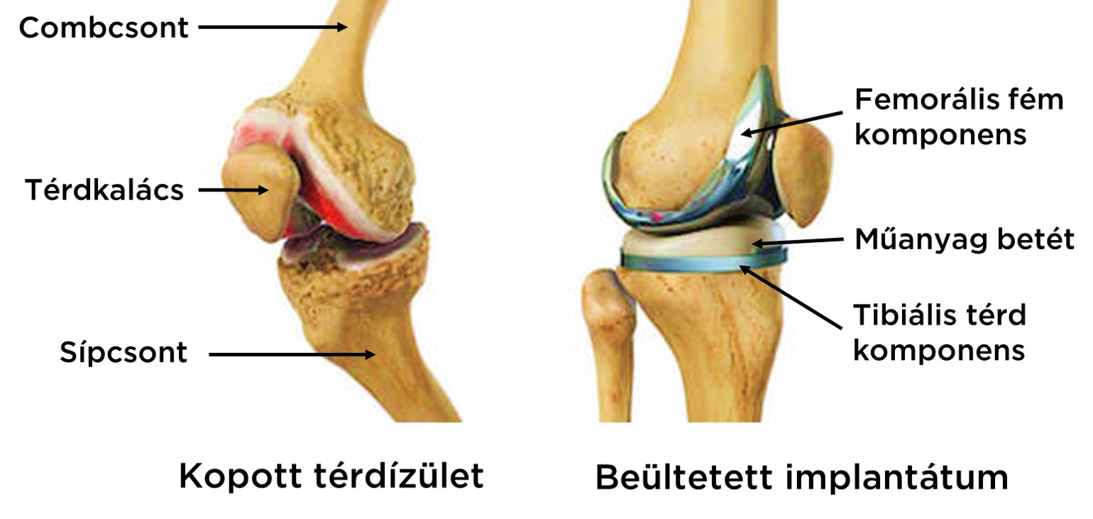 térdízület ortopédiai kezelése)